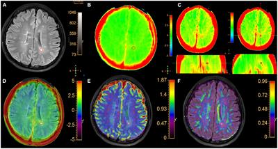 Altered amide proton transfer weighted and diffusion signals in patients with multiple sclerosis: correlation with neurofilament light chain and disease duration